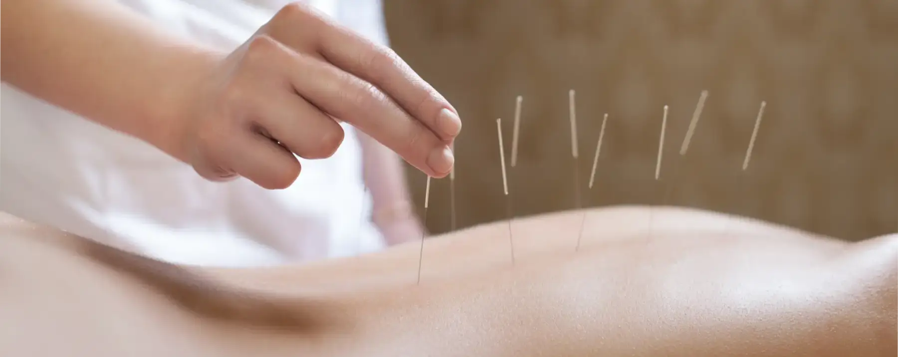 acupuncture